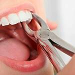 Tooth Decay What Are the Most Common Symptoms - Keep Fit Kingdom