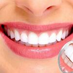 Why Veneers are Very Effective at Arresting Common Tooth Issues KEEP FIT KINGDOM