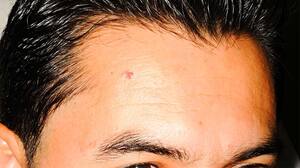 What Does Skin Cancer On The Forehead Look Like KEEP FIT KINGDOM