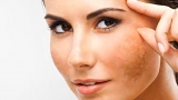 Melasma Treatment Singapore: Causes, Symptoms & Prevention