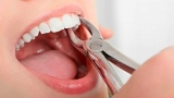 Tooth Decay: 5 Common Symptoms & Tips to Avoid It!