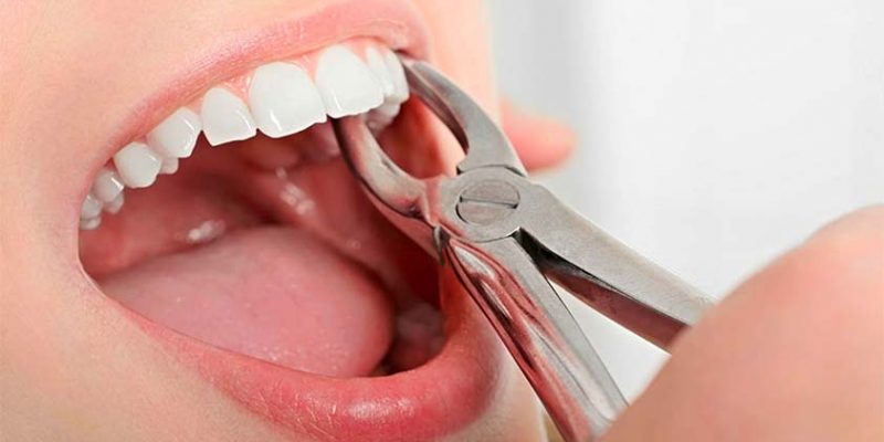 Tooth Decay: 5 Common Symptoms & Tips to Avoid It!