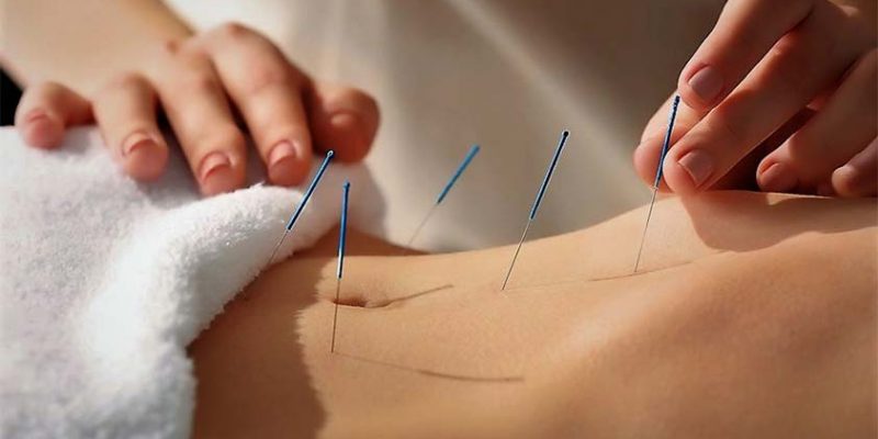 Top 5 Benefits of Acupuncture