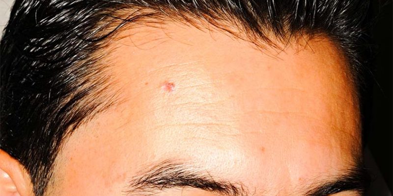 What Does Skin Cancer On The Forehead Look Like?