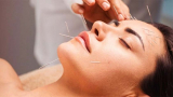 What You Need to Know About Acupuncture in Station Square