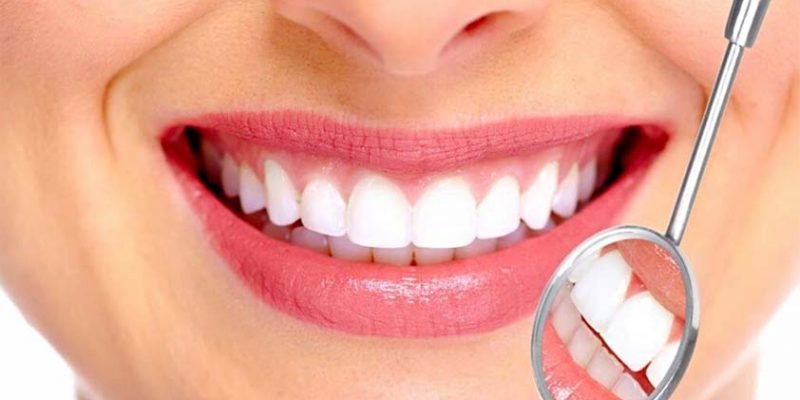 Why Veneers are Very Effective at Arresting Common Tooth Issues